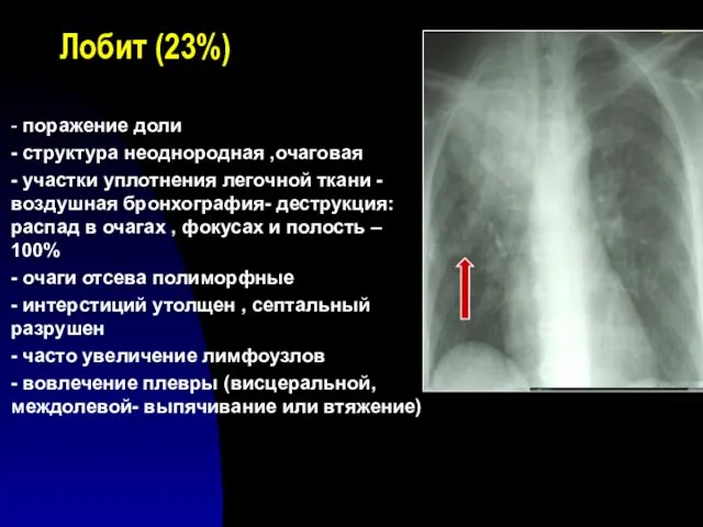 Лобит (23%) - поражение доли - структура неоднородная ,очаговая -