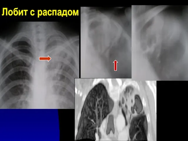 Лобит с распадом