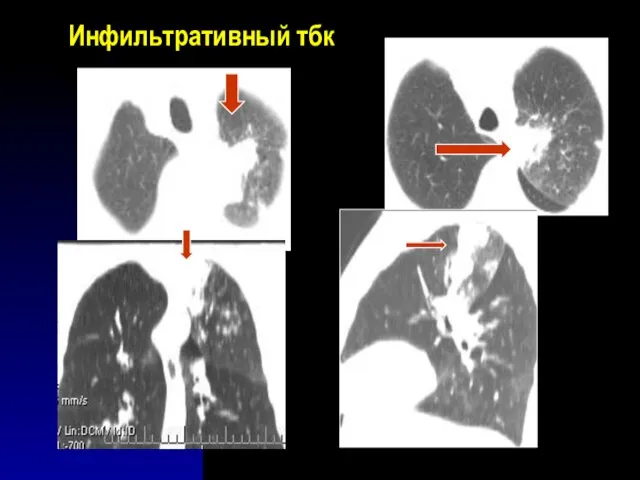 Инфильтративный тбк