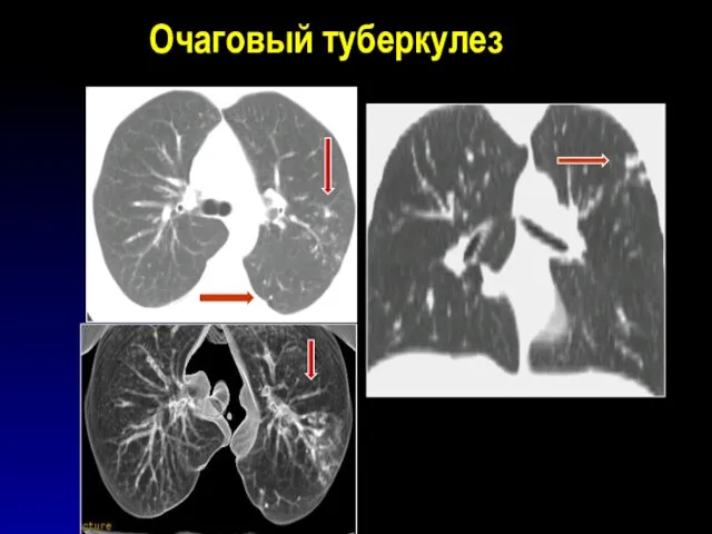 Очаговый туберкулез