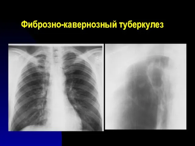 Фиброзно-кавернозный туберкулез