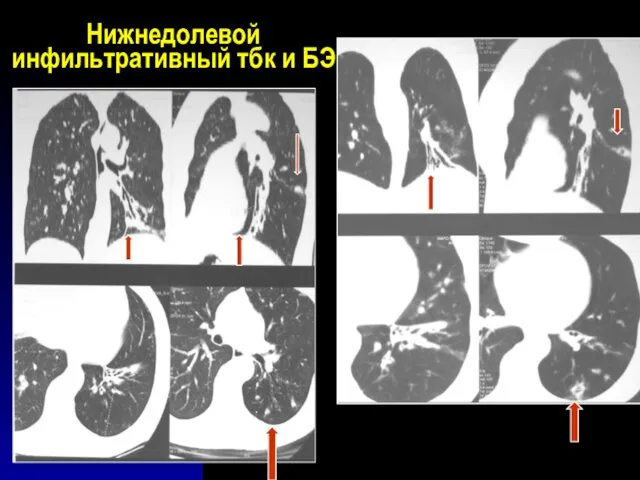 Нижнедолевой инфильтративный тбк и БЭ