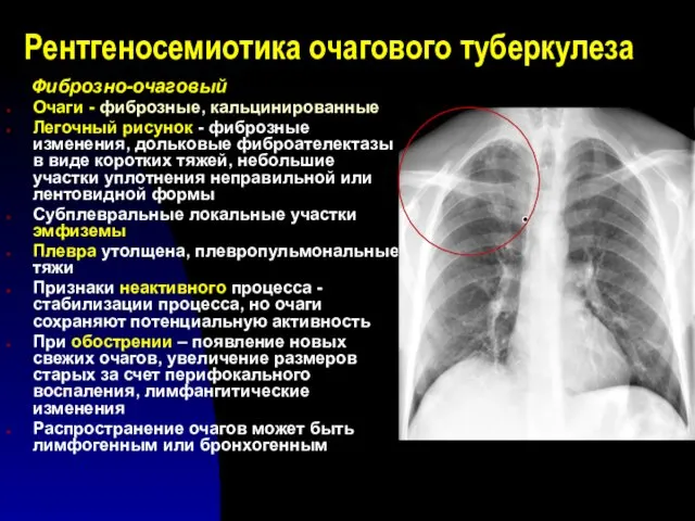 Рентгеносемиотика очагового туберкулеза Фиброзно-очаговый Очаги - фиброзные, кальцинированные Легочный рисунок