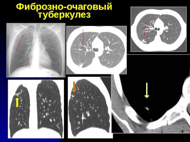 Фиброзно-очаговый туберкулез