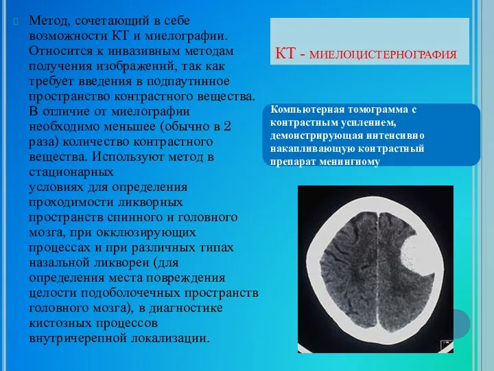 КТ - миелоцистернография Метод, сочетающий в себе возможности КТ и