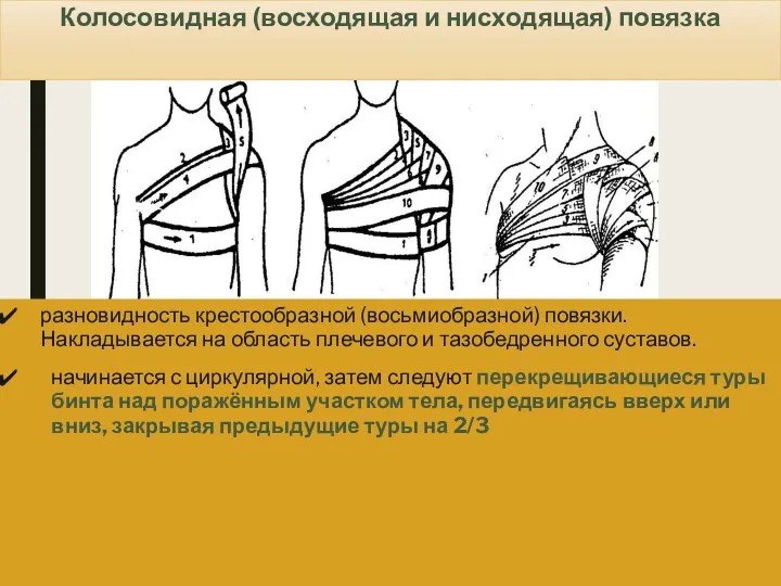 Колосовидная (восходящая и нисходящая) повязка разновидность крестообразной (восьмиобразной) повязки. Накладывается