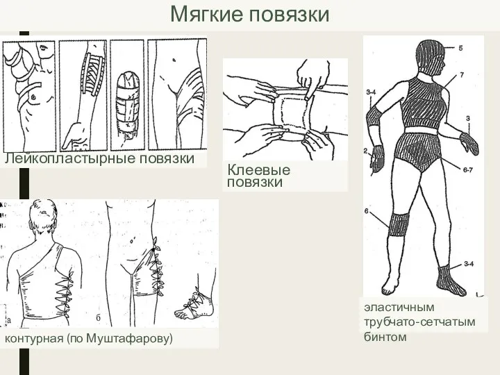 Мягкие повязки Лейкопластырные повязки Клеевые повязки эластичным трубчато-сетчатым бинтом контурная (по Муштафарову)