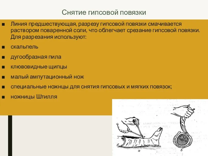 Снятие гипсовой повязки Линия предшествующая, разрезу гипсовой повязки смачивается раствором