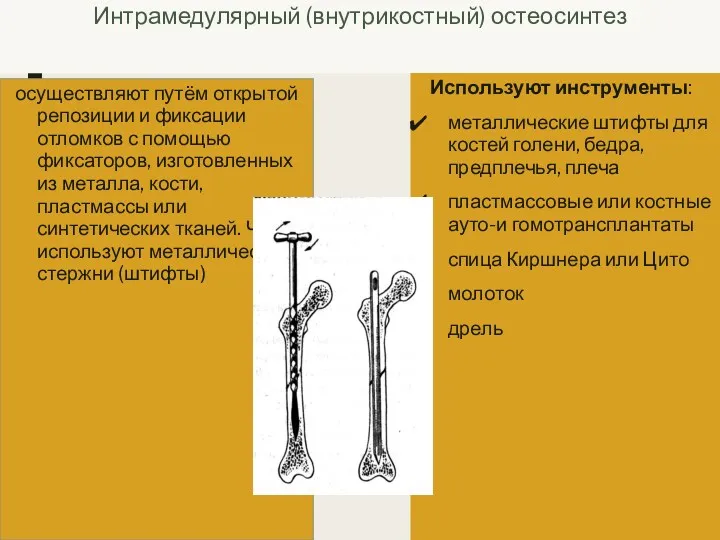 Интрамедулярный (внутрикостный) остеосинтез осуществляют путём открытой репозиции и фиксации отломков