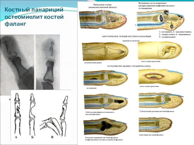 Костный панариций остеомиелит костей фаланг