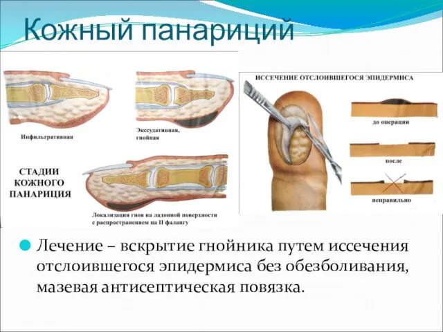 Кожный панариций Лечение – вскрытие гнойника путем иссечения отслоившегося эпидермиса без обезболивания, мазевая антисептическая повязка.