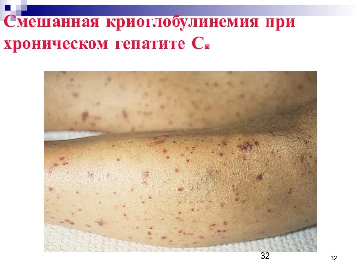 Смешанная криоглобулинемия при хроническом гепатите С.