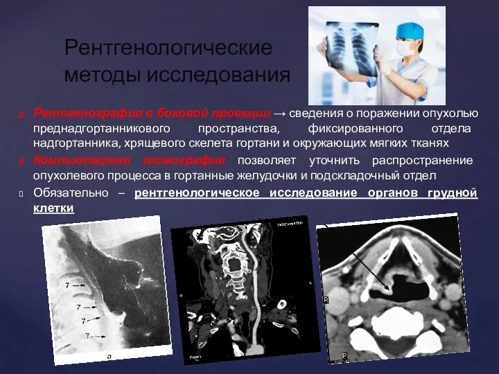 Рентгенография в боковой проекции → сведения о поражении опухолью преднадгортанникового пространства, фиксированного отдела
