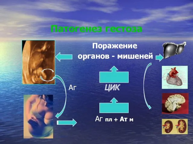 Патогенез гестоза Поражение органов - мишеней Аг ЦИК Аг пл + Ат м