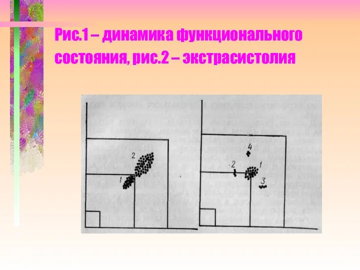 Рис.1 – динамика функционального состояния, рис.2 – экстрасистолия