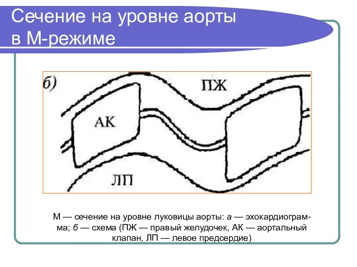 Сечение на уровне аорты в М-режиме М — сечение на уровне луковицы аорты: