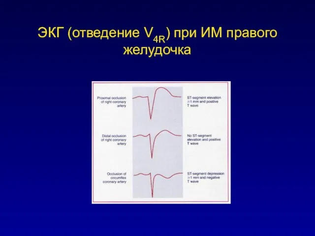 ЭКГ (отведение V4R) при ИМ правого желудочка