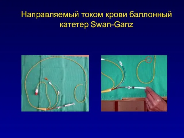 Направляемый током крови баллонный катетер Swan-Ganz