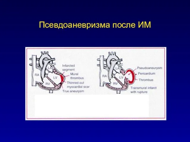 Псевдоаневризма после ИМ