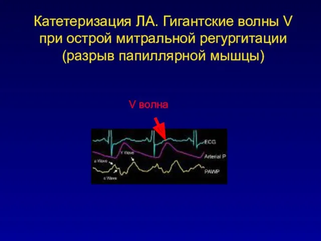 V волна