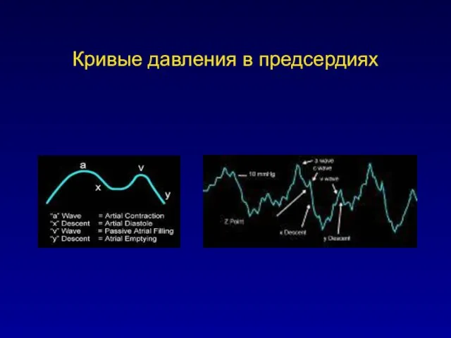 Кривые давления в предсердиях