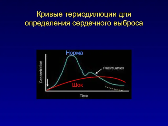 Кривые термодилюции для определения сердечного выброса Норма Шок