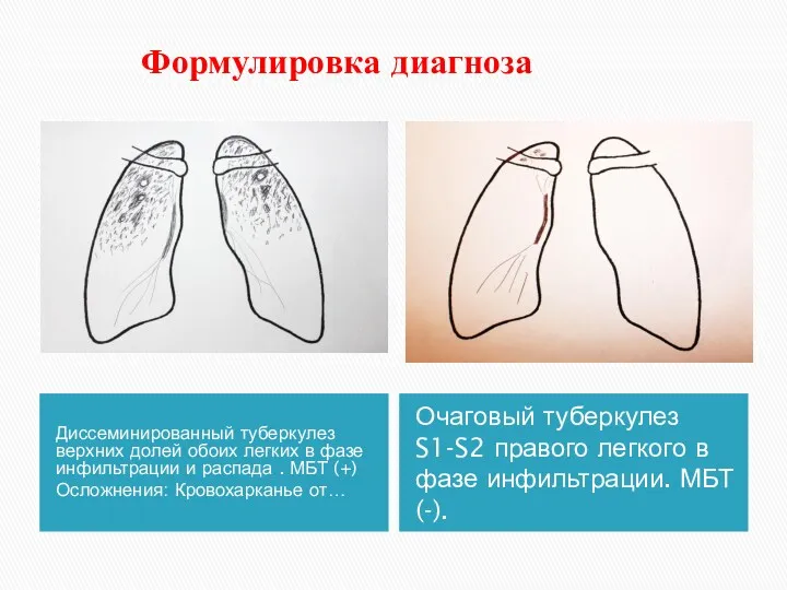 Формулировка диагноза Диссеминированный туберкулез верхних долей обоих легких в фазе