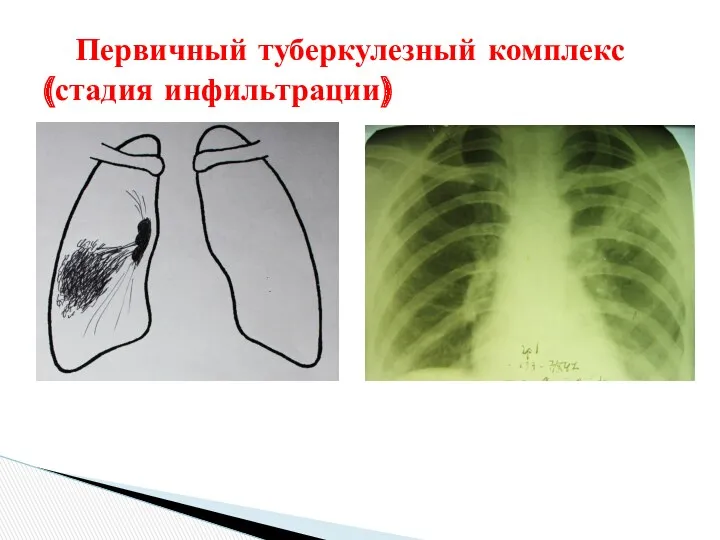 Первичный туберкулезный комплекс (стадия инфильтрации)