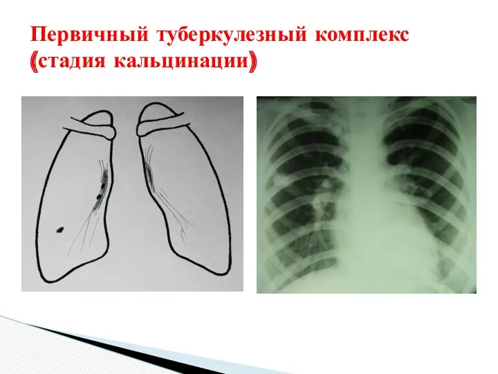 Первичный туберкулезный комплекс (стадия кальцинации)