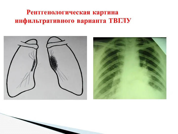 Рентгенологическая картина инфильтративного варианта ТВГЛУ