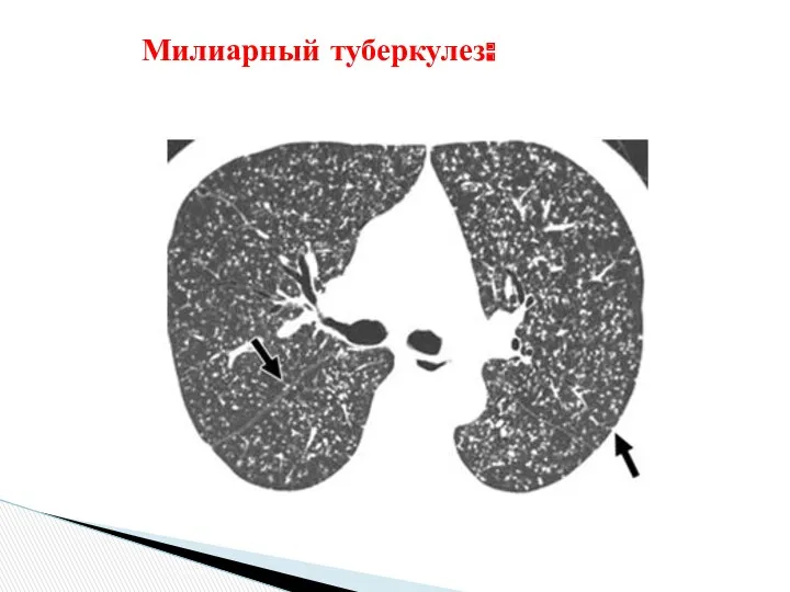 Милиарный туберкулез: