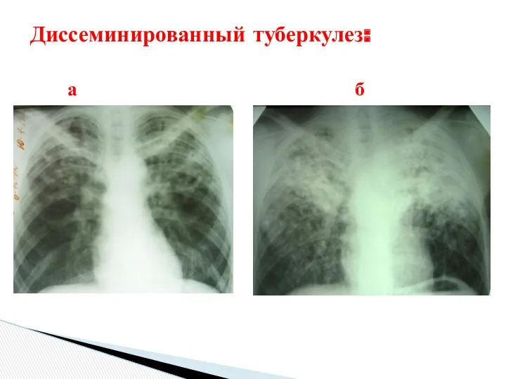 Диссеминированный туберкулез: а б