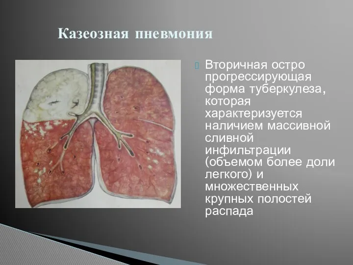 Вторичная остро прогрессирующая форма туберкулеза, которая характеризуется наличием массивной сливной