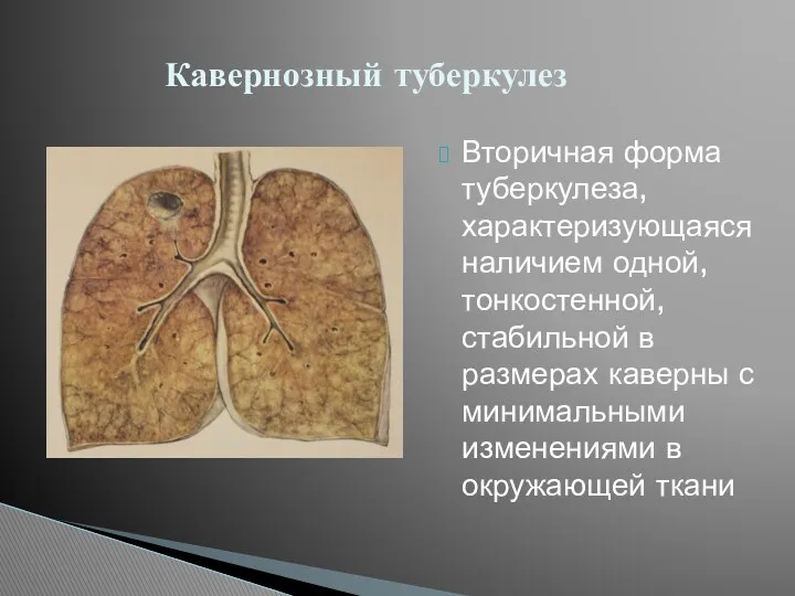 Вторичная форма туберкулеза, характеризующаяся наличием одной, тонкостенной, стабильной в размерах