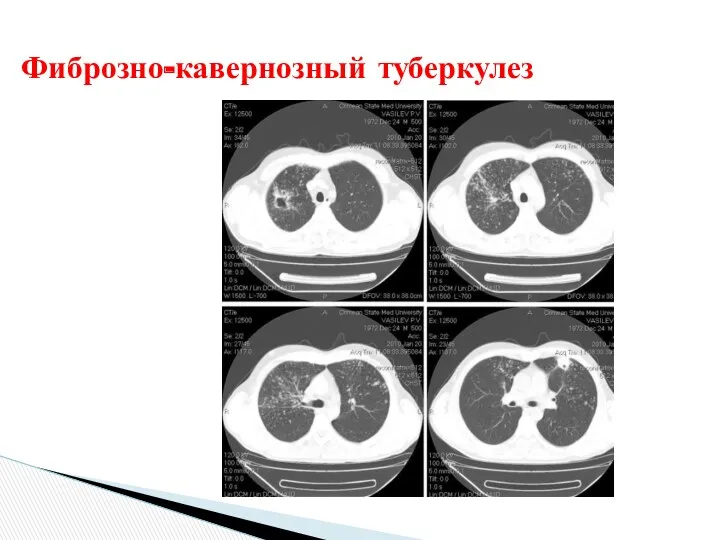 Фиброзно-кавернозный туберкулез