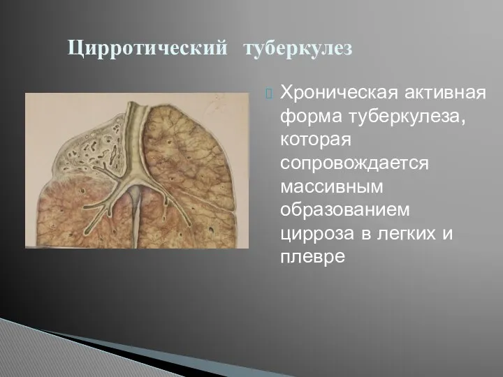 Хроническая активная форма туберкулеза, которая сопровождается массивным образованием цирроза в легких и плевре Цирротический туберкулез