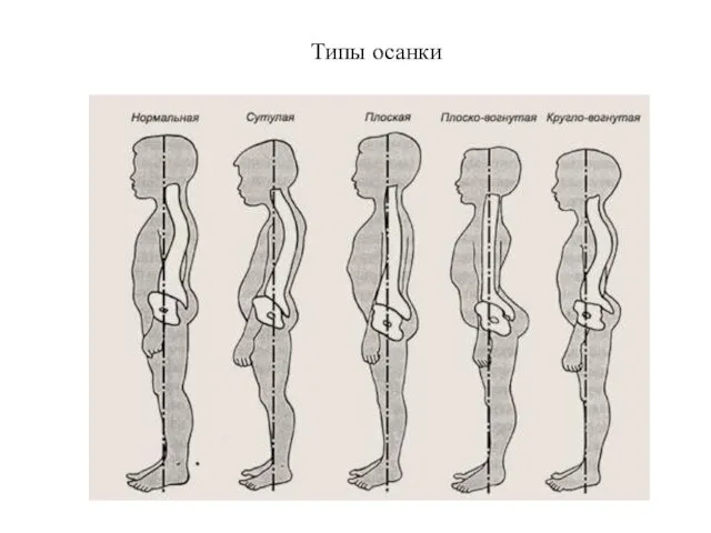 Типы осанки