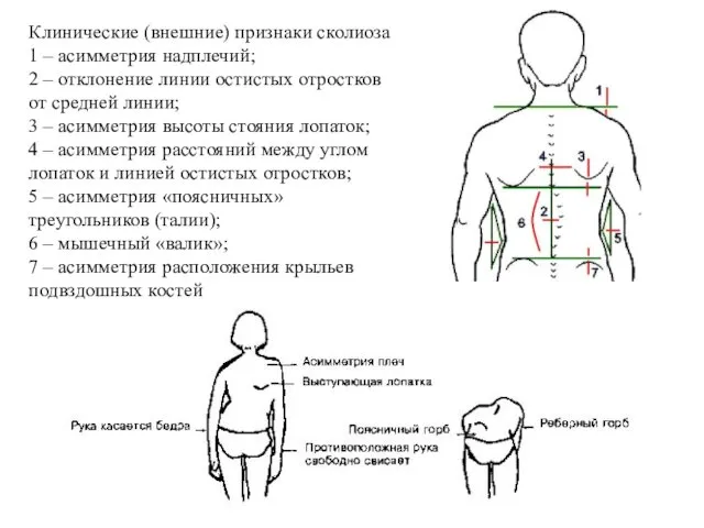 Клинические (внешние) признаки сколиоза 1 – асимметрия надплечий; 2 –