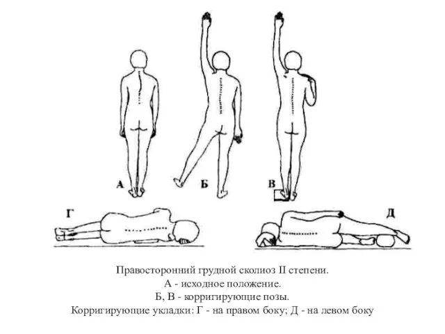 Правосторонний грудной сколиоз II степени. А - исходное положение. Б,