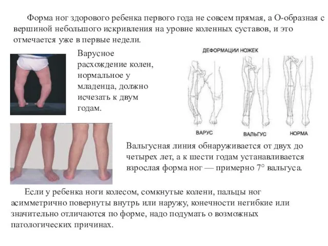 Варусное расхождение колен, нормальное у младенца, должно исчезать к двум