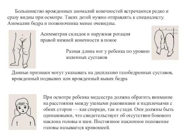 Большинство врожденных аномалий конечностей встречаются редко и сразу видны при