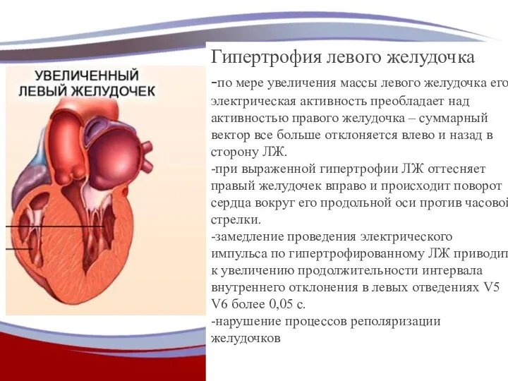 Гипертрофия левого желудочка -по мере увеличения массы левого желудочка его