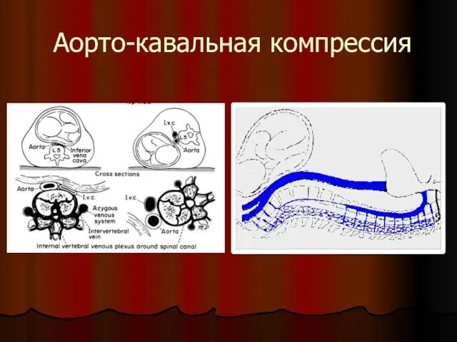 Аорто-кавальная компрессия