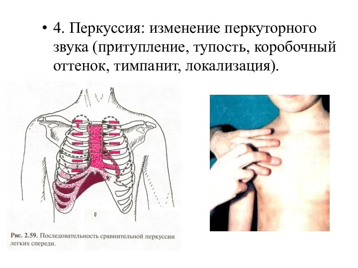 4. Перкуссия: изменение перкуторного звука (притупление, тупость, коробочный оттенок, тимпанит, локализация).