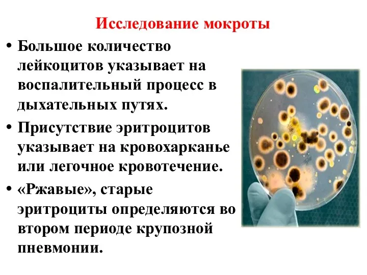 Исследование мокроты Большое количество лейкоцитов указывает на воспалительный процесс в