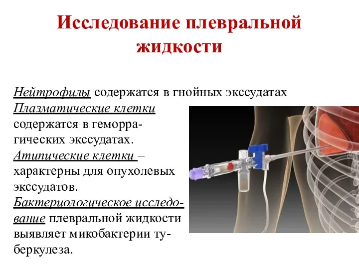 Исследование плевральной жидкости Нейтрофилы содержатся в гнойных экссудатах Плазматические клетки