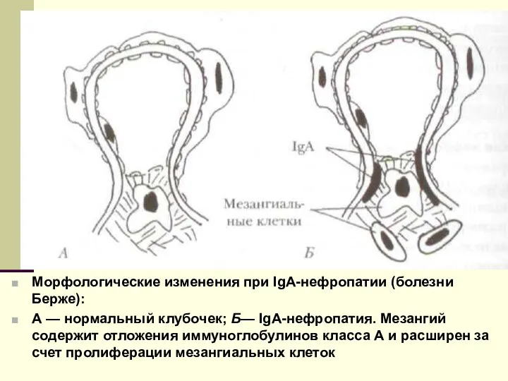 Морфологические изменения при IgA-нефропатии (болезни Берже): А — нормальный клубочек;