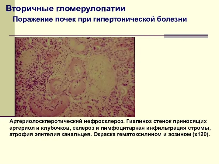 Вторичные гломерулопатии Артериолосклеротический нефросклероз. Гиалиноз стенок приносящих артериол и клубочков,