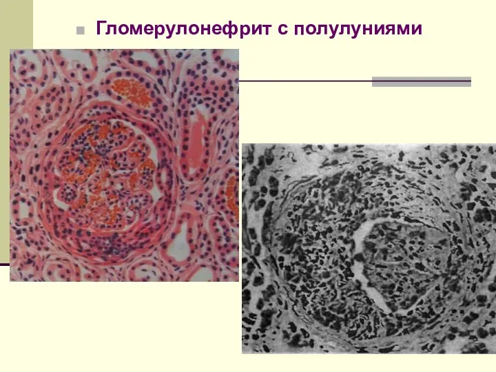 Гломерулонефрит с полулуниями