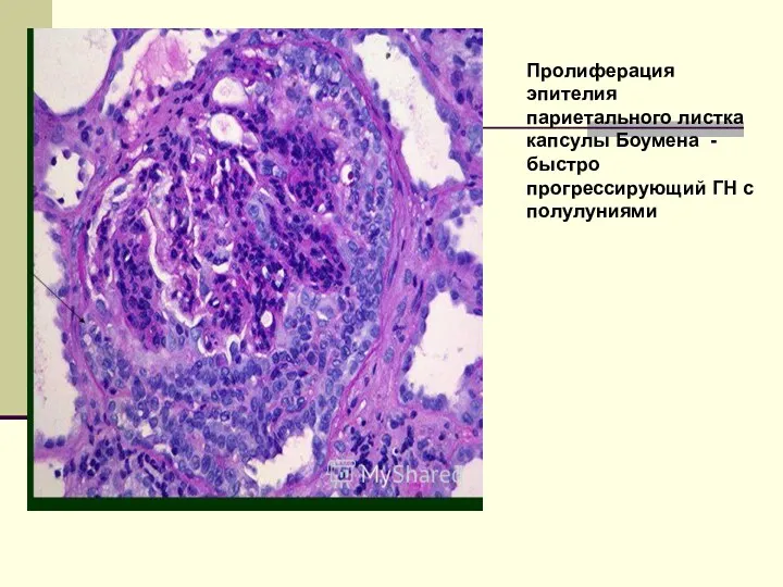 Пролиферация эпителия париетального листка капсулы Боумена - быстро прогрессирующий ГН с полулуниями